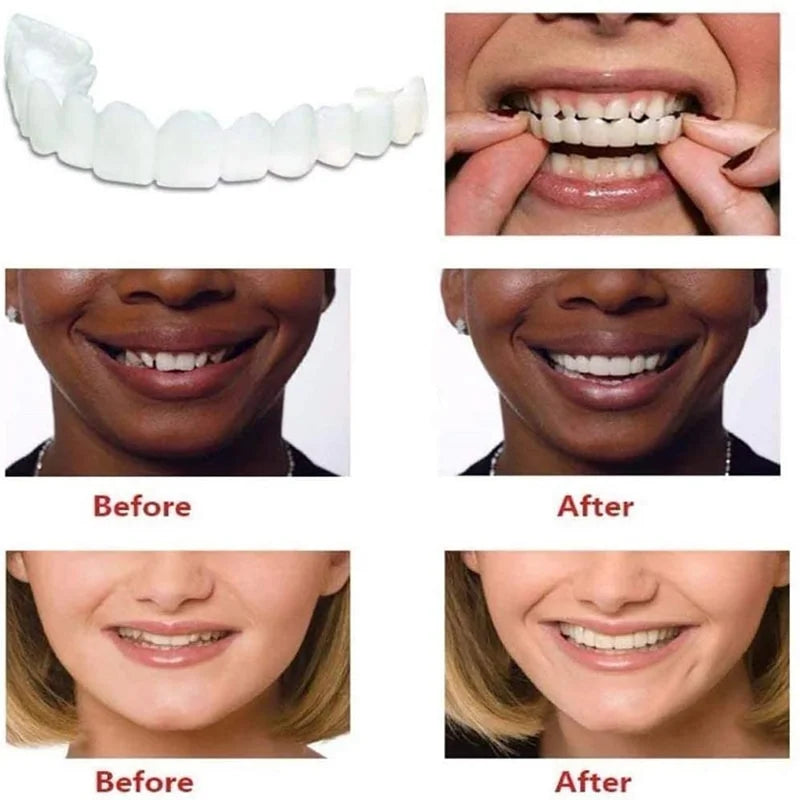 Instant Smile Reusable Snap On Veneers (Upper & Lower) - Free Delivery
